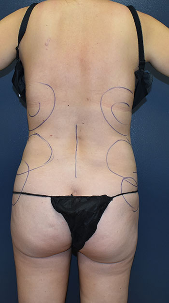 Abdominoplasty