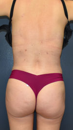 Abdominoplasty