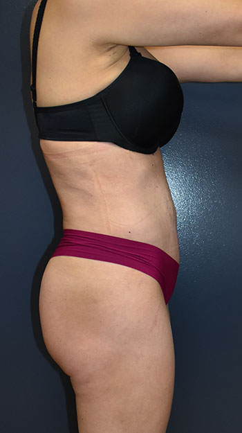 Abdominoplasty