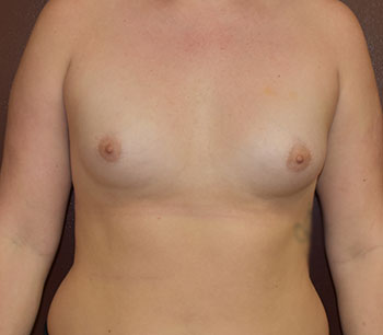 Breast Augmentation