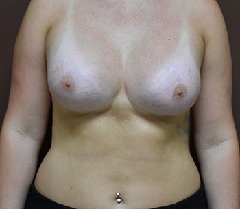 Breast Augmentation
