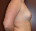 Breast Augmentation