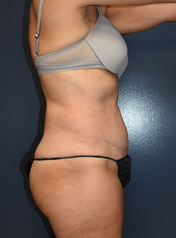 Abdominoplasty