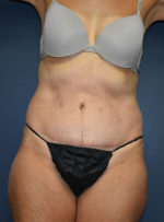 Abdominoplasty