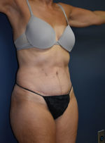 Abdominoplasty