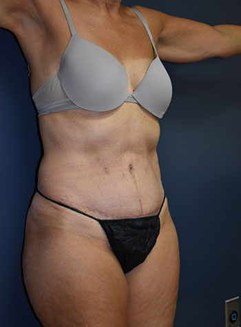 Abdominoplasty