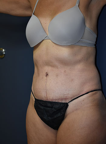 Abdominoplasty