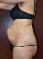 Abdominoplasty