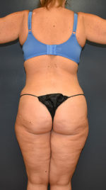 Abdominoplasty