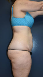 Abdominoplasty