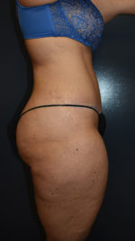 Abdominoplasty