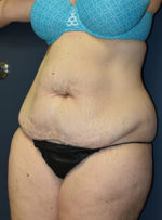 Abdominoplasty