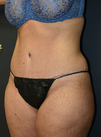 Abdominoplasty