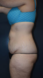 Abdominoplasty