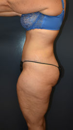 Abdominoplasty