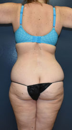 Abdominoplasty