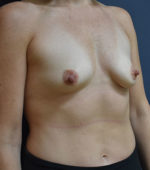 Breast Asymmetry