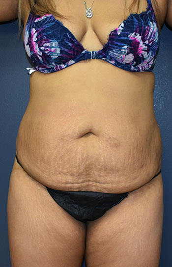 Abdominoplasty