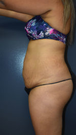 Abdominoplasty