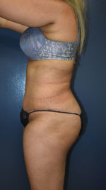 Abdominoplasty