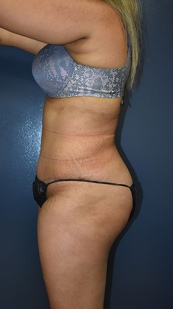 Abdominoplasty