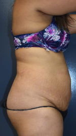 Abdominoplasty