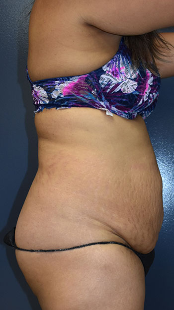 Abdominoplasty