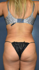 Abdominoplasty