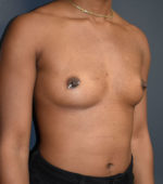 Breast Augmentation