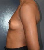 Breast Augmentation