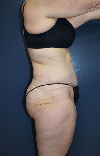 Abdominoplasty