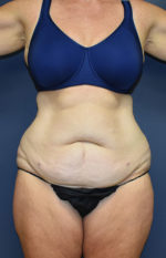 Abdominoplasty