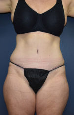 Abdominoplasty