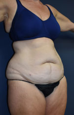 Abdominoplasty