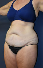 Abdominoplasty