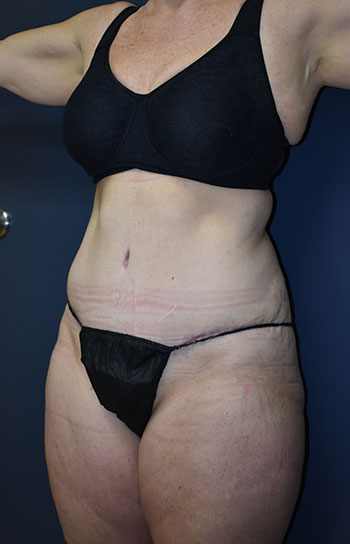 Abdominoplasty