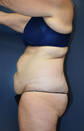 Abdominoplasty