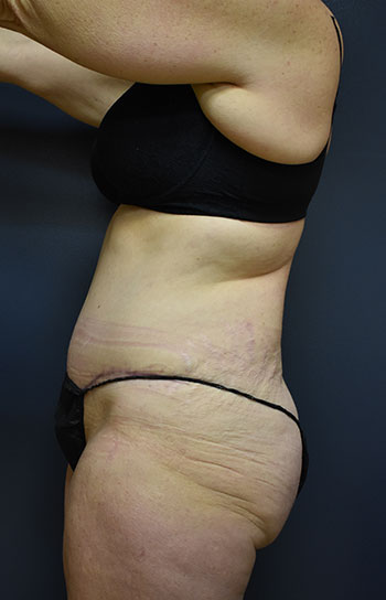 Abdominoplasty