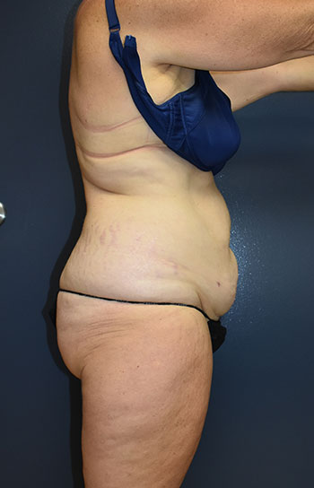 Abdominoplasty