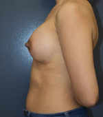 Breast Augmentation