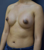 Breast Augmentation