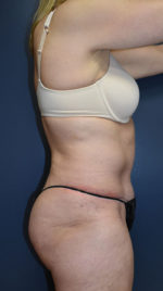 Abdominoplasty