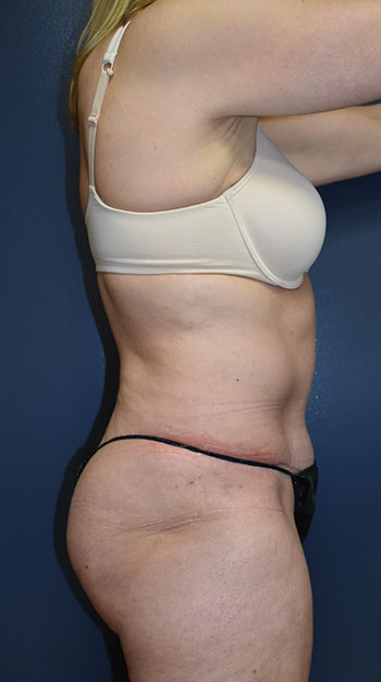 Abdominoplasty