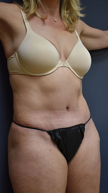Abdominoplasty