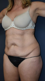Abdominoplasty