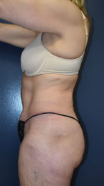Abdominoplasty