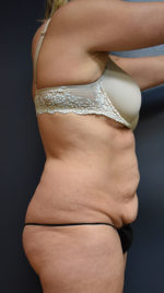Abdominoplasty