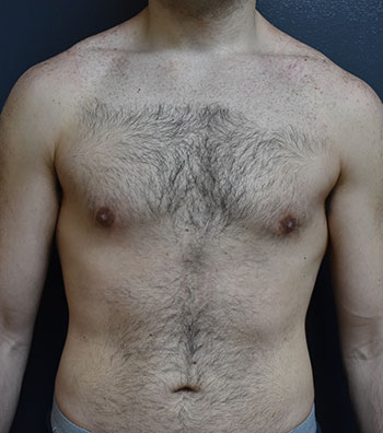 Gynecomastia - Male Breast Reduction