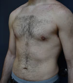 Gynecomastia - Male Breast Reduction