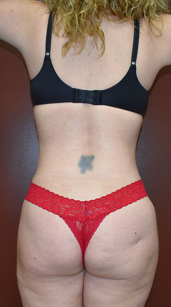 Abdominoplasty